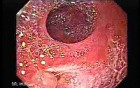 Ileal Neobladder Substitution (ileal bladder) (2 of 9)