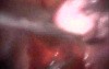 Laparoscopic Myomectomy  