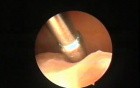Excision of Uterine Polyps