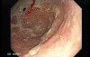 Adenocarcinoma of the Cardias - Assessment of Infiltration