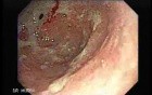 Adenocarcinoma of the Cardias - Assessment of Infiltration