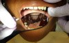 Removable Partial Denture Framework 