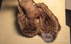 Plastic Linitis with bilateral Krukenberg´s tumor (4 of 13)