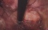 Laparoscopic Abdominoperineal Resection 