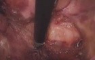 Laparoscopic Abdominoperineal Resection 