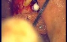 Regeneration Of Multialveolar Process (Right-Side) (1/3)