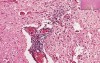 Skeletal Muscle, Spinal Cord - Poliomyelitis