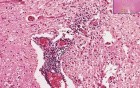 Skeletal Muscle, Spinal Cord - Poliomyelitis