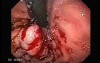 Gastric Varices - Endoscopic Ablation With Cyanoacrylate Glue (2 of 18)