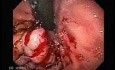 Gastric Varices - Endoscopic Ablation With Cyanoacrylate Glue (2 of 18)