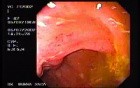 Crohn´s Disease (19 of 28)