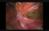 Robotic Hand Assisted Left Donor Nephrectomy