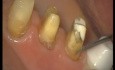 Glass Ionomer Cementation (1/6)
