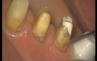 Glass Ionomer Cementation (1/6)