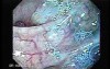 Sigmoid Diverticulitis - Colovesical Fistula (4 of 8)