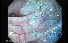 Sigmoid Diverticulitis - Colovesical Fistula (4 of 8)