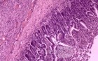 Jejunal Gastrointestinal Stromal tumor (GIST) (11 of 86)