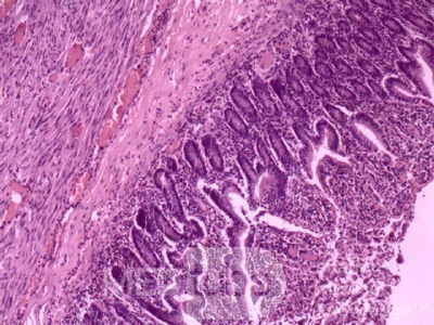 Jejunal Gastrointestinal Stromal tumor (GIST) (11 of 86)
