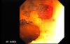 Barrett's Esophagus of long segment (19 of 24)