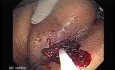 Endoscopic Resection of Giant Tubulo-Villous of the rectum (6 of 35)