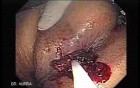 Endoscopic Resection of Giant Tubulo-Villous of the rectum (6 of 35)