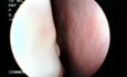 Draining Mucopus along Middle Meatus