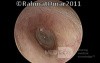 Thickened Eardrum