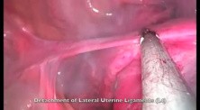 SILS Total Hysterectomy 