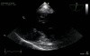 Mitral Valve Regurgitation