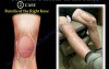 Unusual Bursitis Of The Knee - Video Lecture