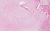 Skin - Keloid