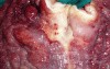 Endoscopy of Scirrhous Gastric Carcinoma involving the entire Fundus, Body and the Antrum (39 of 47)