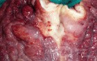 Endoscopy of Scirrhous Gastric Carcinoma involving the entire Fundus, Body and the Antrum (39 of 47)