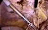 Abdominal Surgery Complications