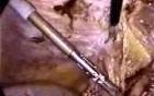 Abdominal Surgery Complications
