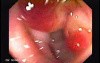 Endoscopic View Of Diverticulitis Of The Sigmoid (2 of 4)