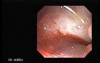 Traqueostomy Fistula (5 of 5)