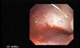 Traqueostomy Fistula (5 of 5)