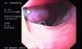 Banding of esophageal varices (6 of 17)