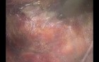 Robotic Total Mesorectal Excision Practical Solution Obese Female Patient