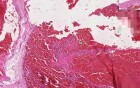 Esophagus - Ruptured Varices