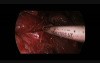 Uniportal VATS Lower Lobectomy Adenomatoid Cystic Malformation And Bronchial Atresia