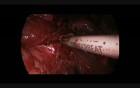 Uniportal VATS Lower Lobectomy Adenomatoid Cystic Malformation And Bronchial Atresia