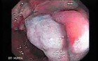 Cap polyposis that resemble a adenocarcinoma of the rectum (4 of 7)
