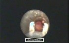 Fb Bronchus 