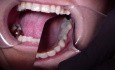 Bridge Insert: Strengthen Your Provisional Fdp With Ribbond