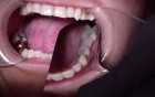 Bridge Insert: Strengthen Your Provisional Fdp With Ribbond
