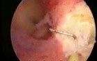 Uterine Septum - Hysteroscopic Resection