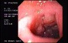 Duodenal B Cell Lymphoma (1 of 7)