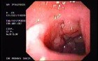 Duodenal B Cell Lymphoma (1 of 7)